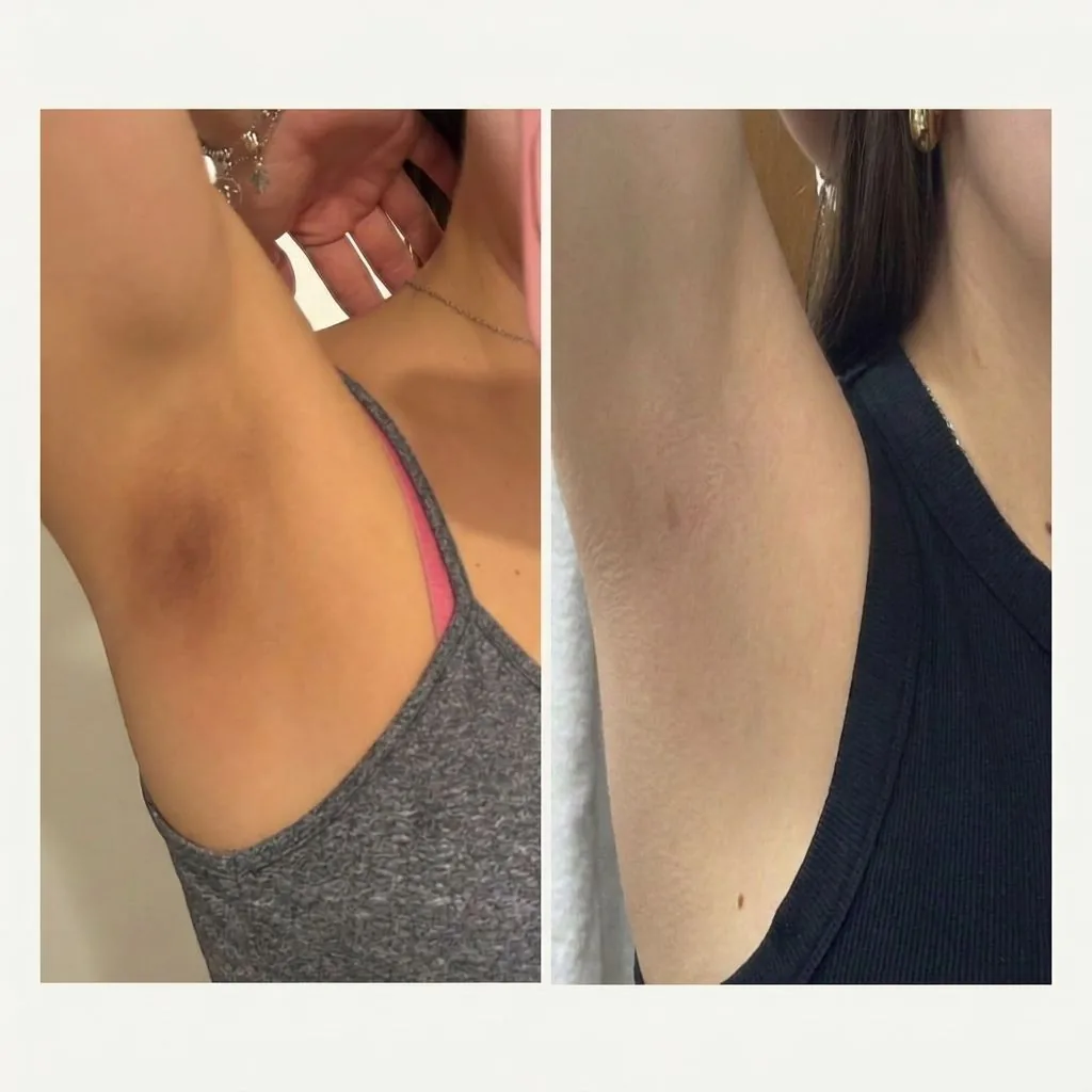 Antes e depois da aparência das axilas