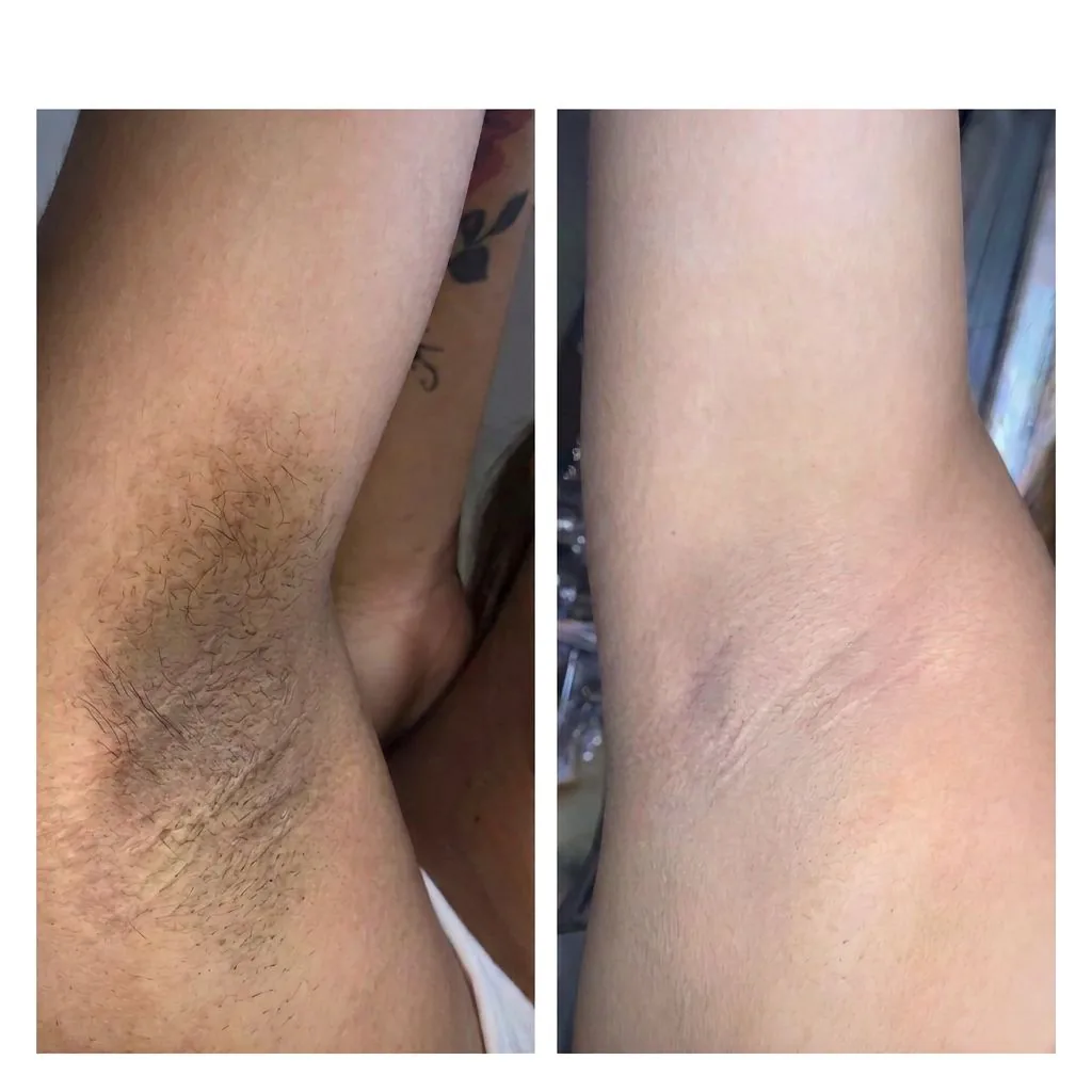 Antes e depois da aparência das axilas