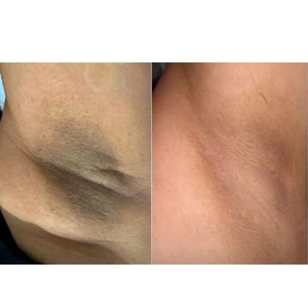 Antes e depois da aparência das axilas