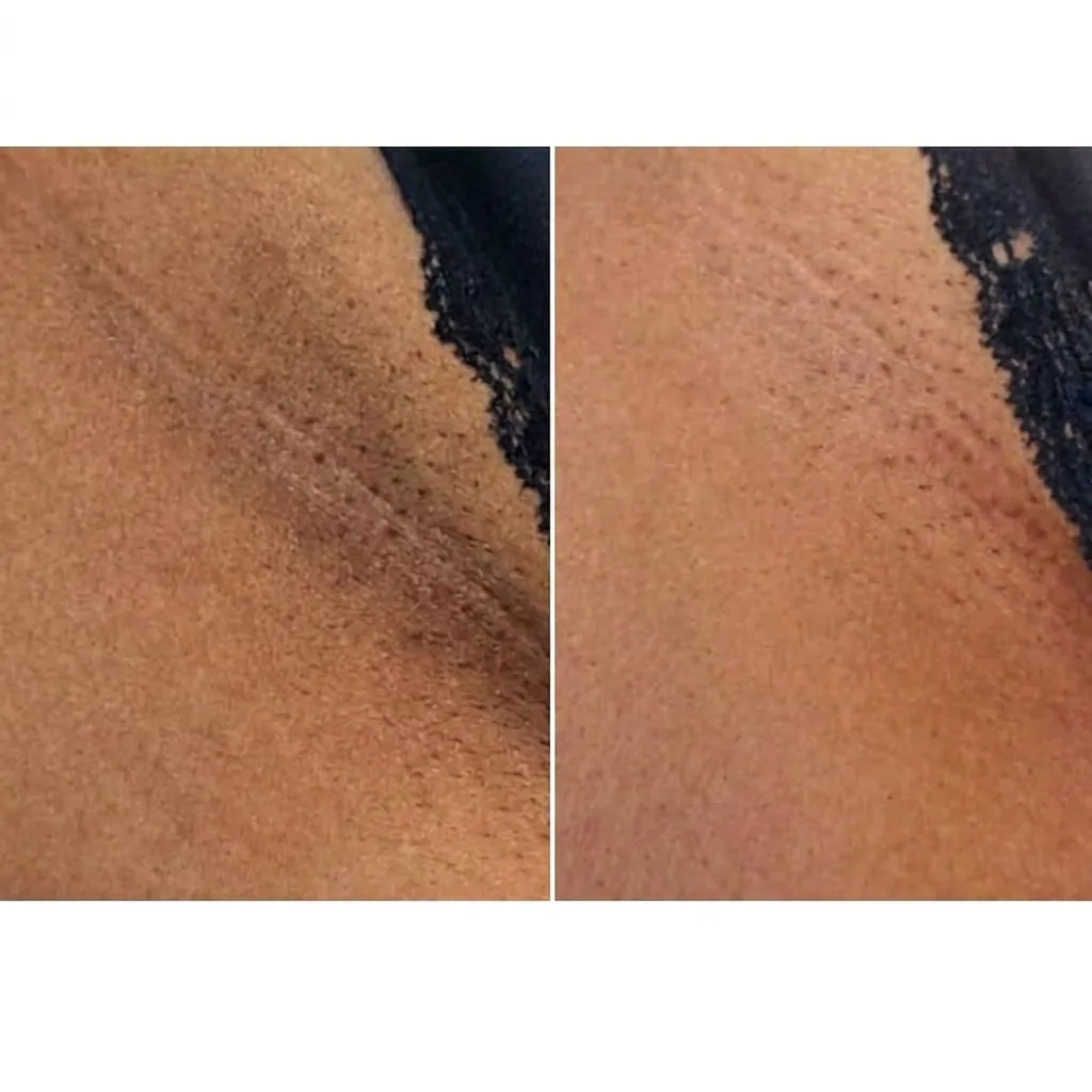 Antes e depois da aparência de área escurecida