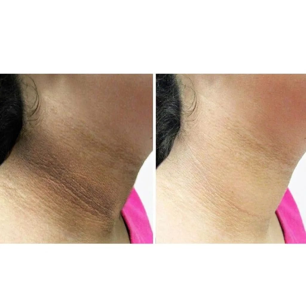 Antes e depois de manchas no pescoço