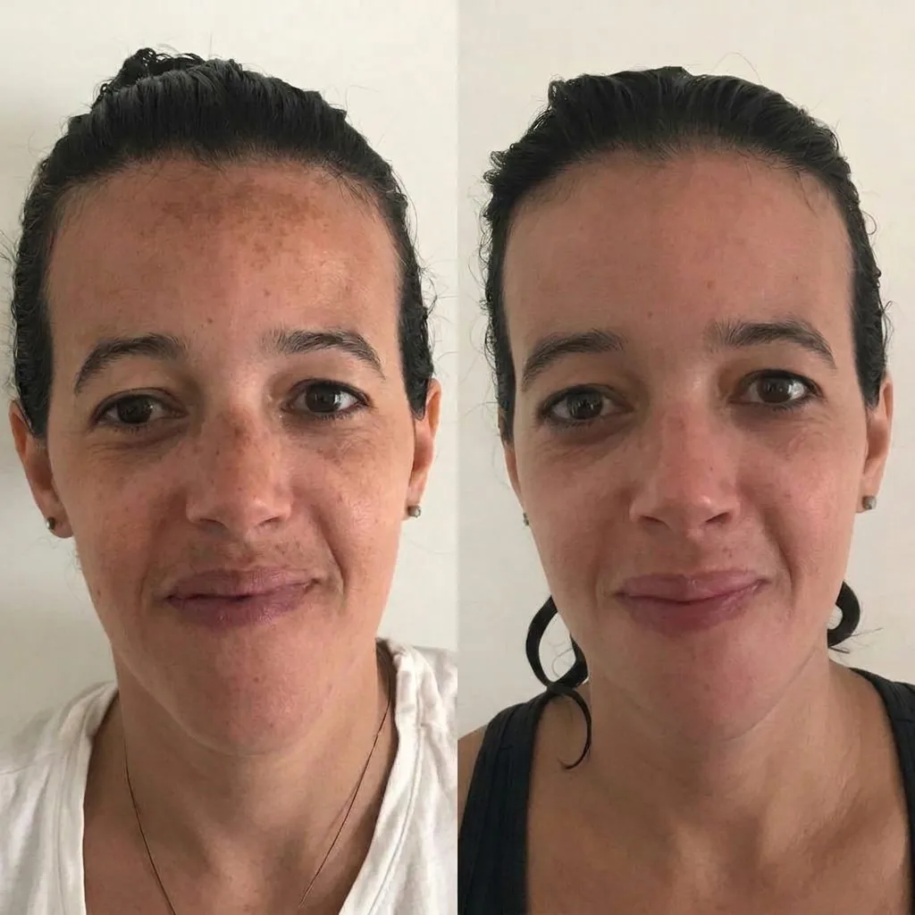 Antes e depois de melasma no rosto